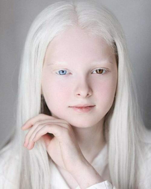 Девушка с альбинизмом и гетерохромией